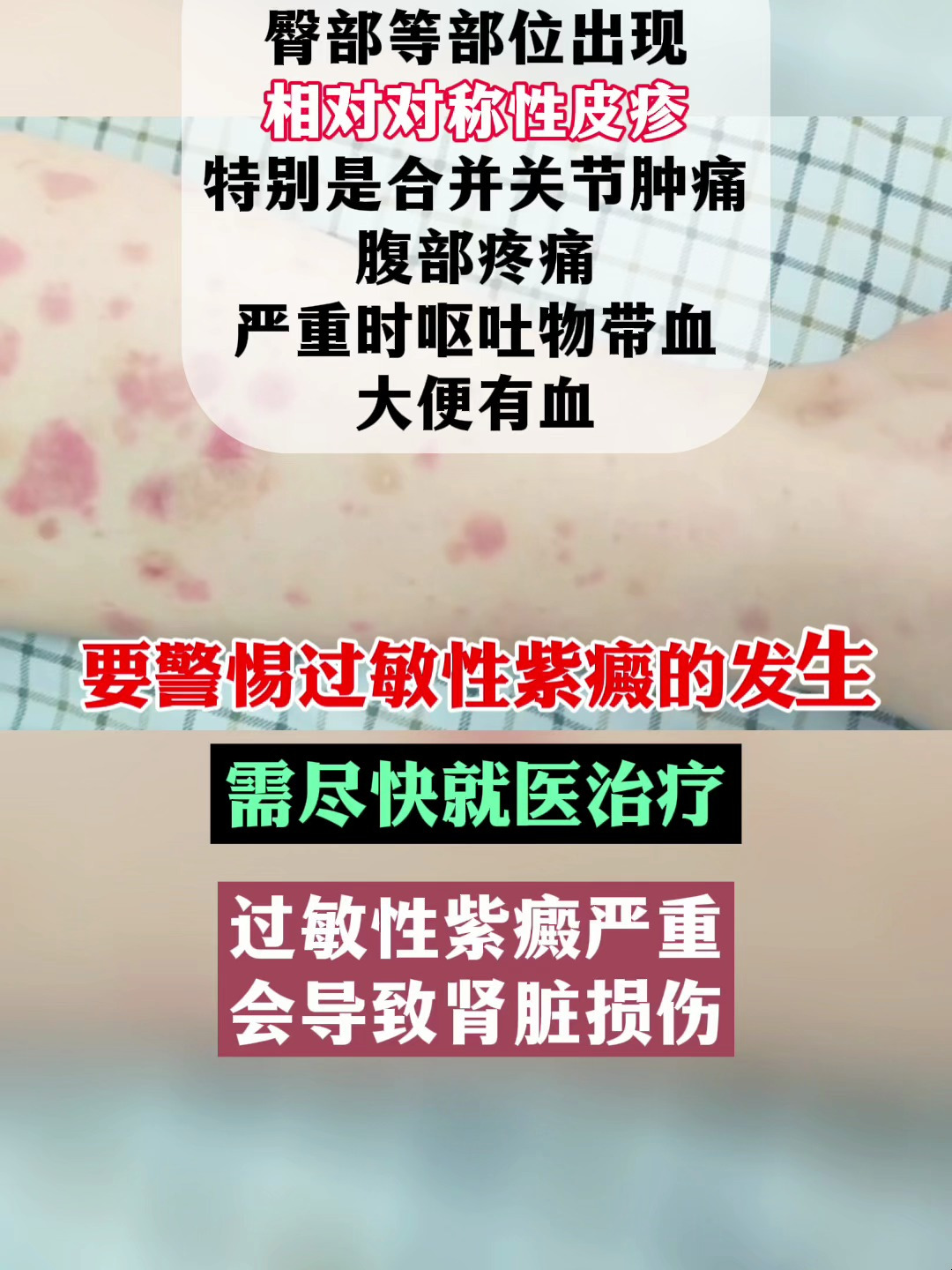 过敏性紫癜尽快治疗需警惕紫癜肾炎