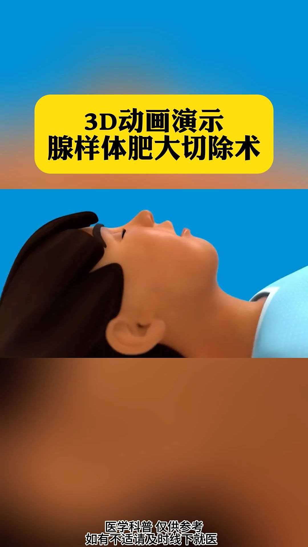 3d动画演示,腺样体肥大切除术