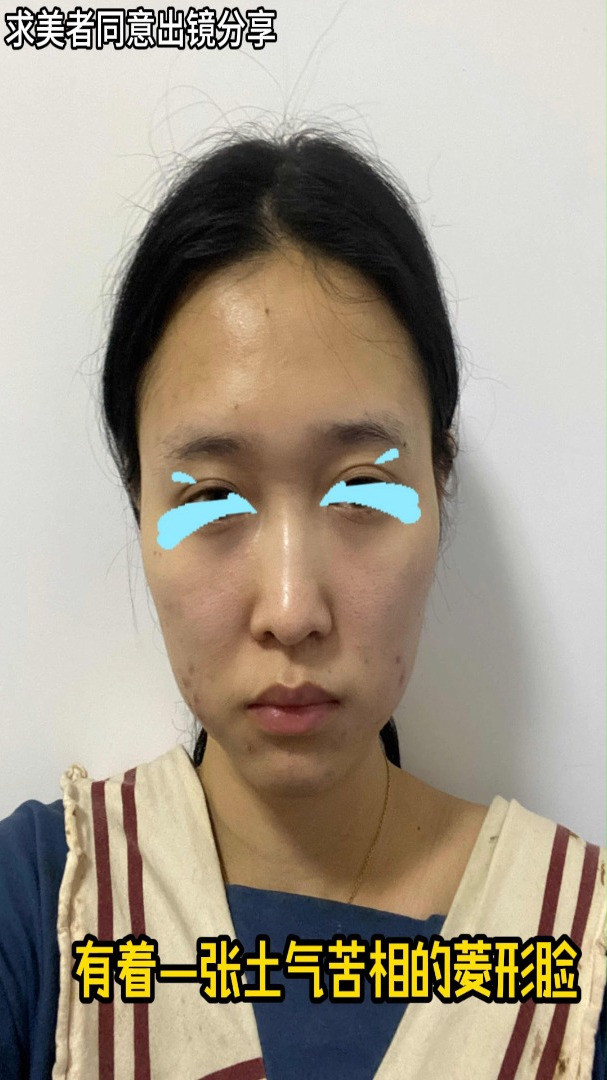 做了颧骨磨骨手术后,终于摆脱了我的苦相脸!