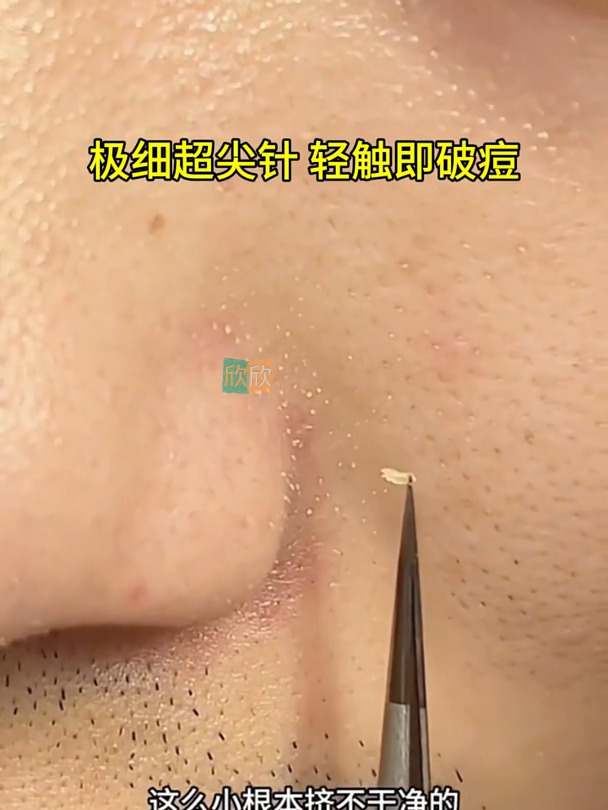 教你如何轻松去痘痘粉刺黑头