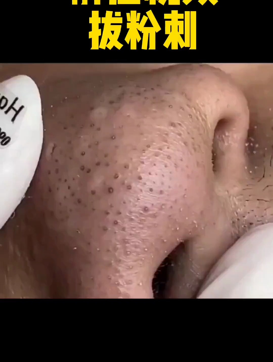 鼻子上的黑头太多了,强迫症必看 黑头粉刺 粉刺针套装 解压视频