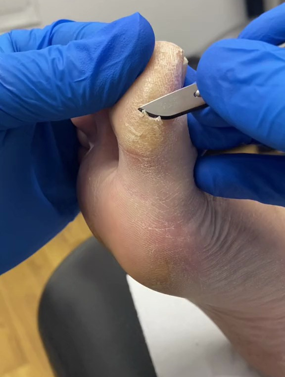 专业修脚,去除大脚趾老茧死皮,超解压