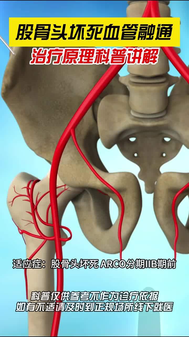 股骨头坏死血供融通手术,动画演示科普讲解
