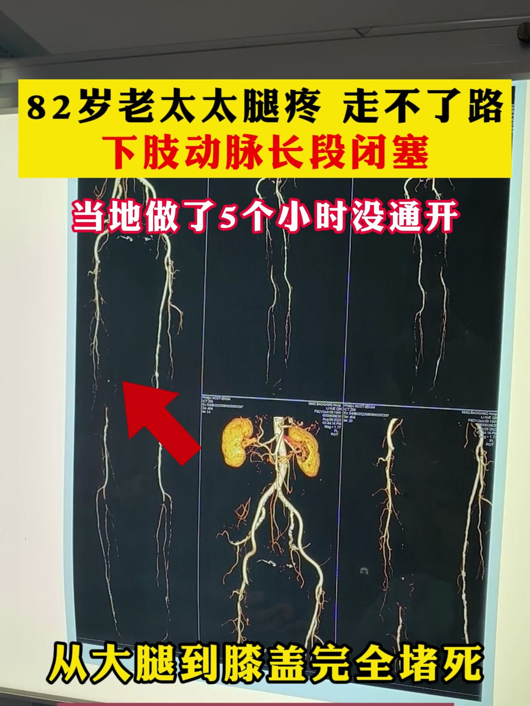 老太太腿疼走不了路 下肢动脉长段闭塞 当地做了5个小时没通开