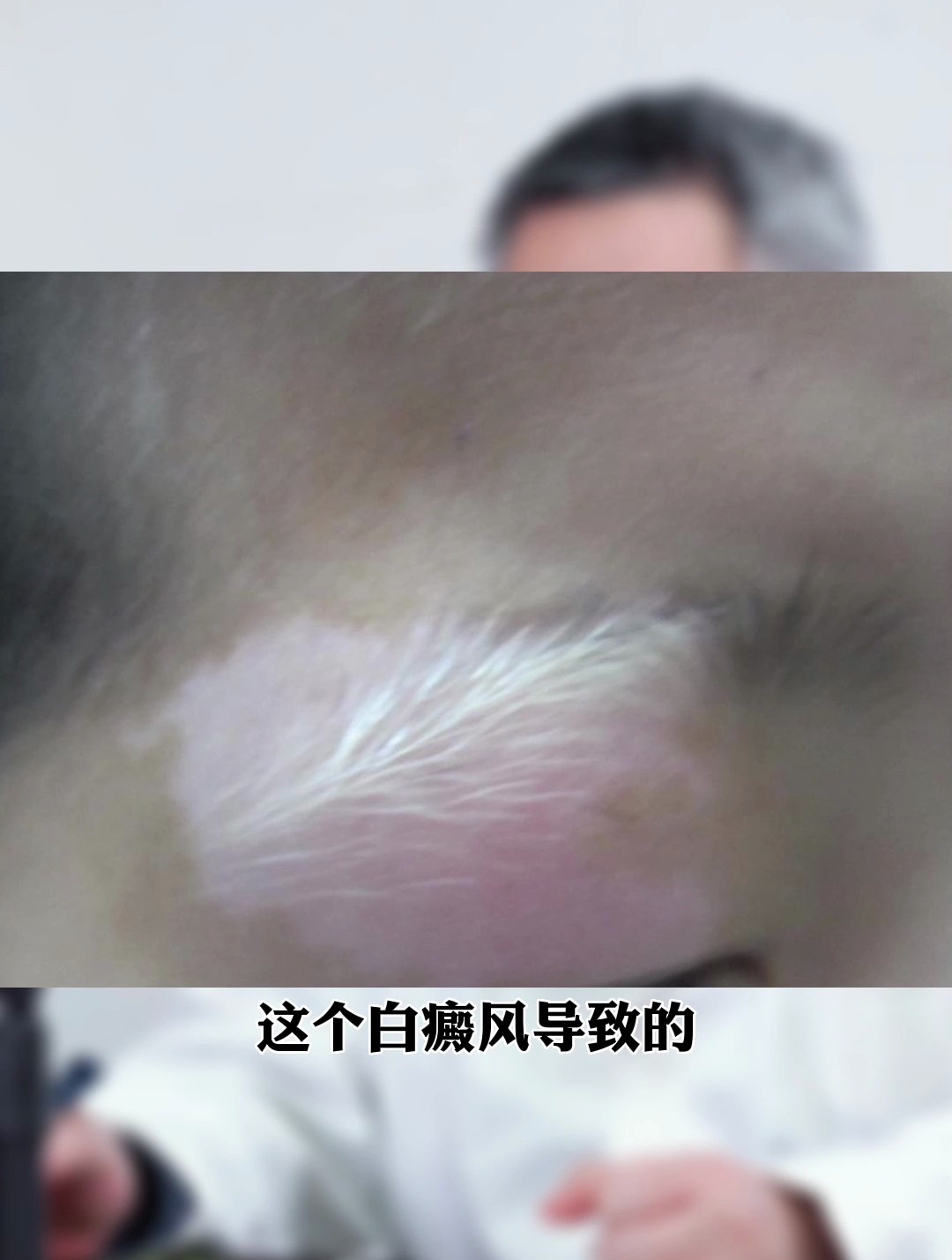 儿童因白癜风眉毛也变白?放心,还能变回来!