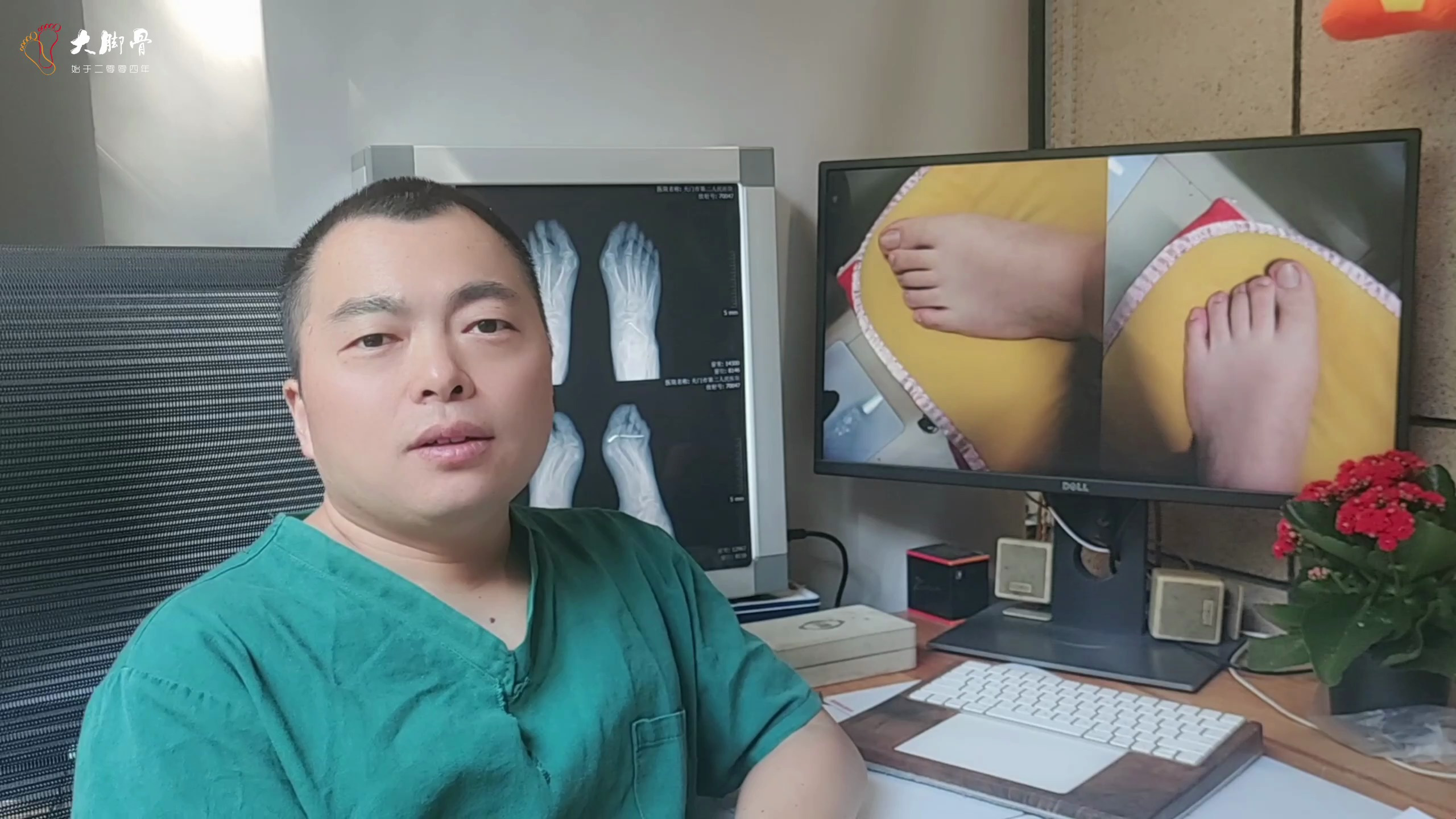 脚趾长怎么办?脚大拇趾长要不要做手术?