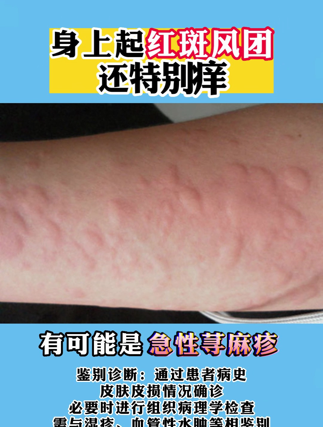 身上起红斑风团还特别痒
