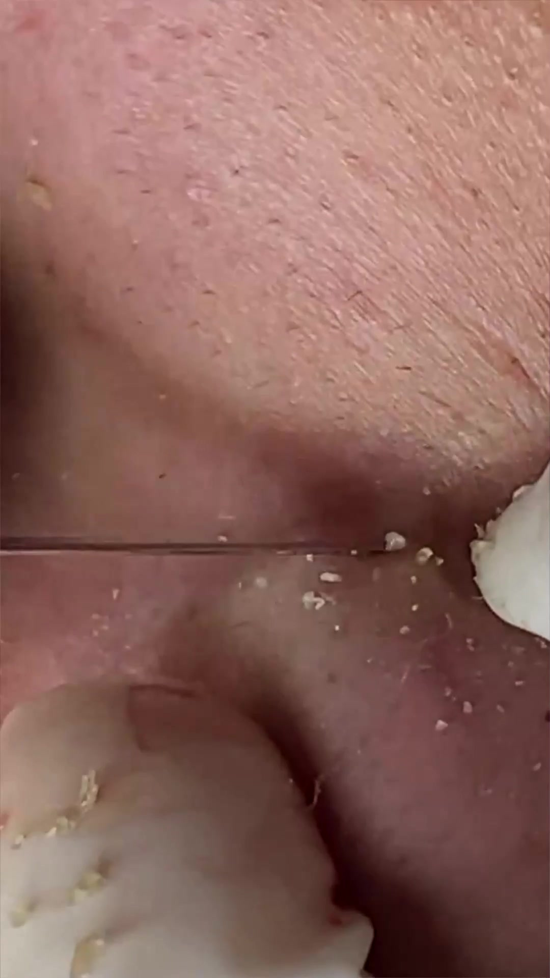 用手挤黑头容易引起皮肤发炎,分享这款美容院同款