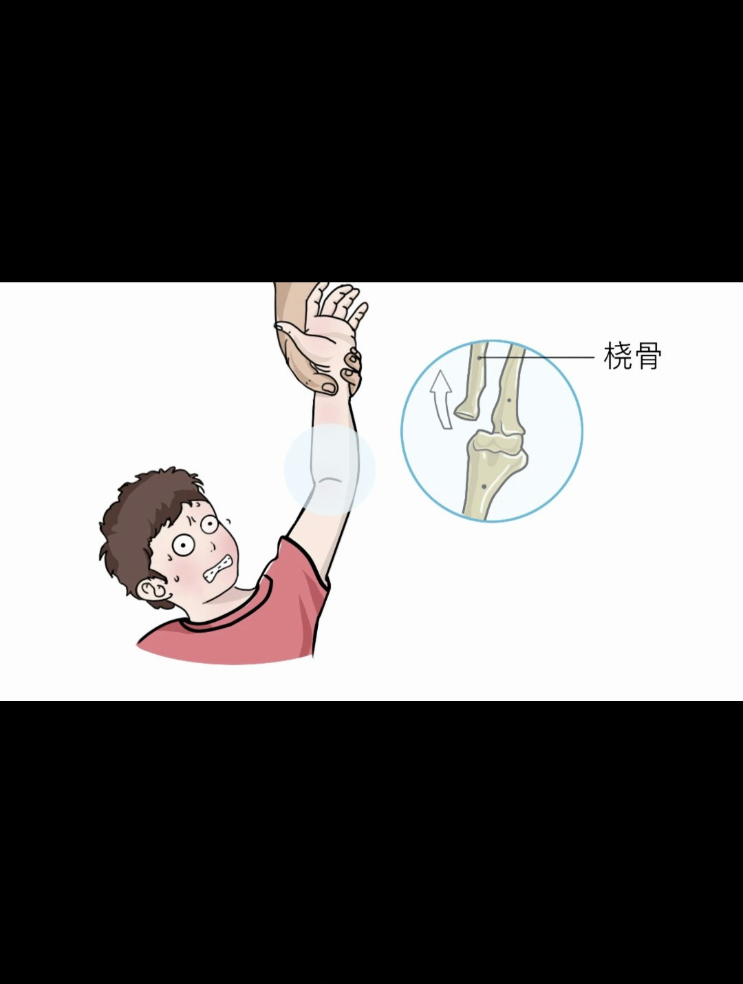 宝宝手臂脱臼 大夫"一秒复位"-度小视