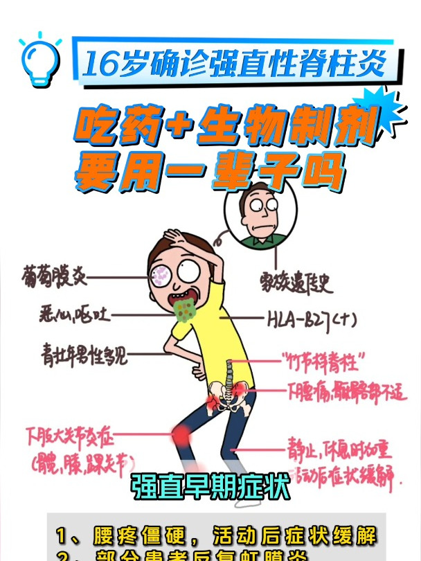 16岁确诊强直性脊柱炎,吃药 打生物制一辈子就这样了吗
