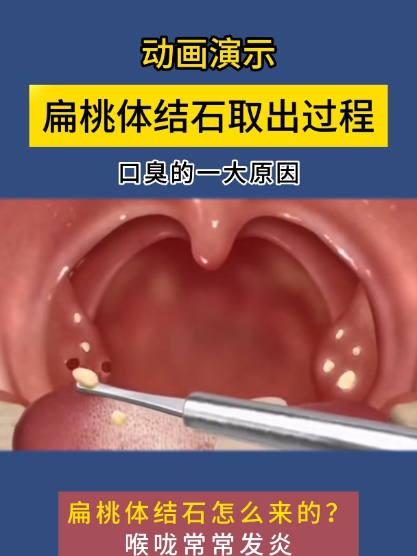 动画演示:扁桃体结石取出的过程-度小视