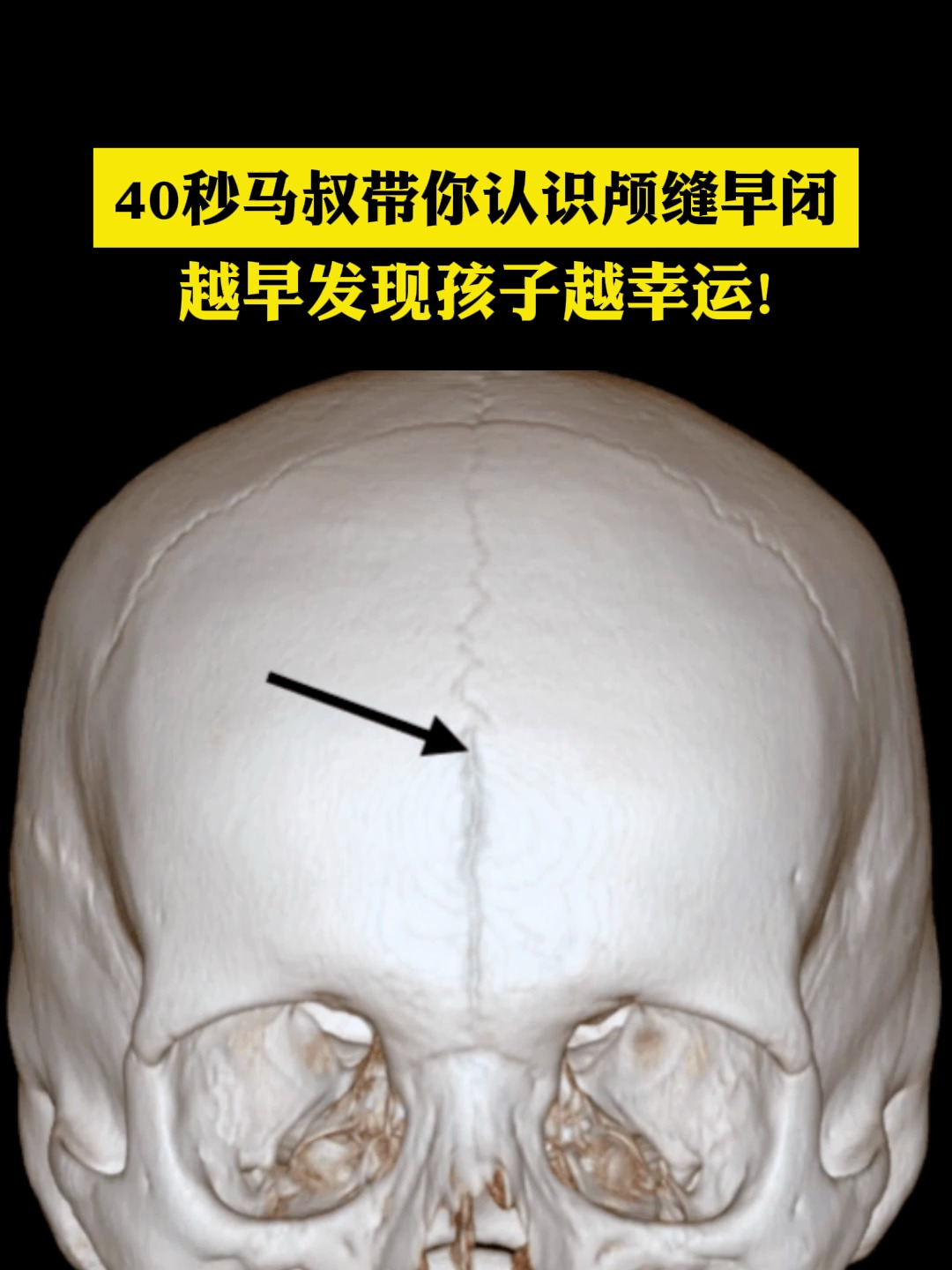 颅缝早闭手术成功率图片