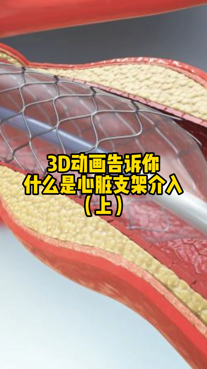 3d动画告诉你:什么是心脏支架介入?
