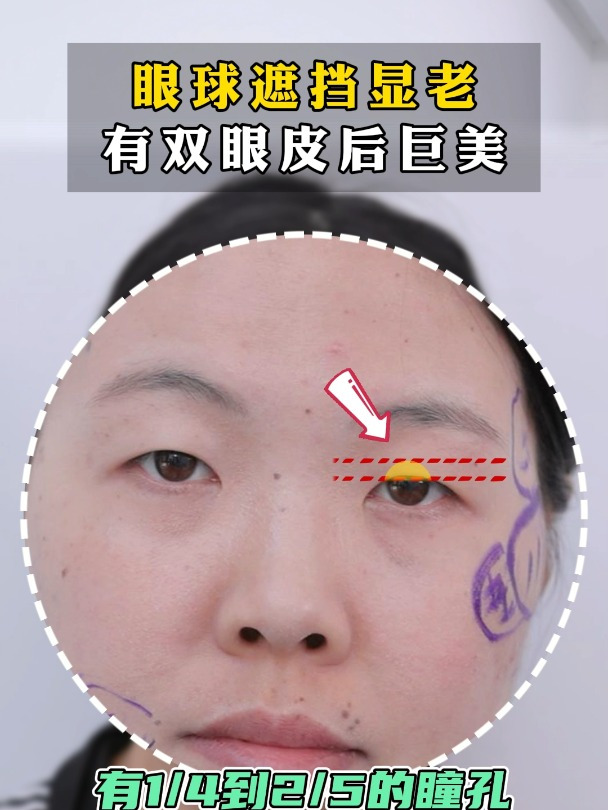 内眦赘皮 眼球遮挡可以通过做双眼皮改善吗?