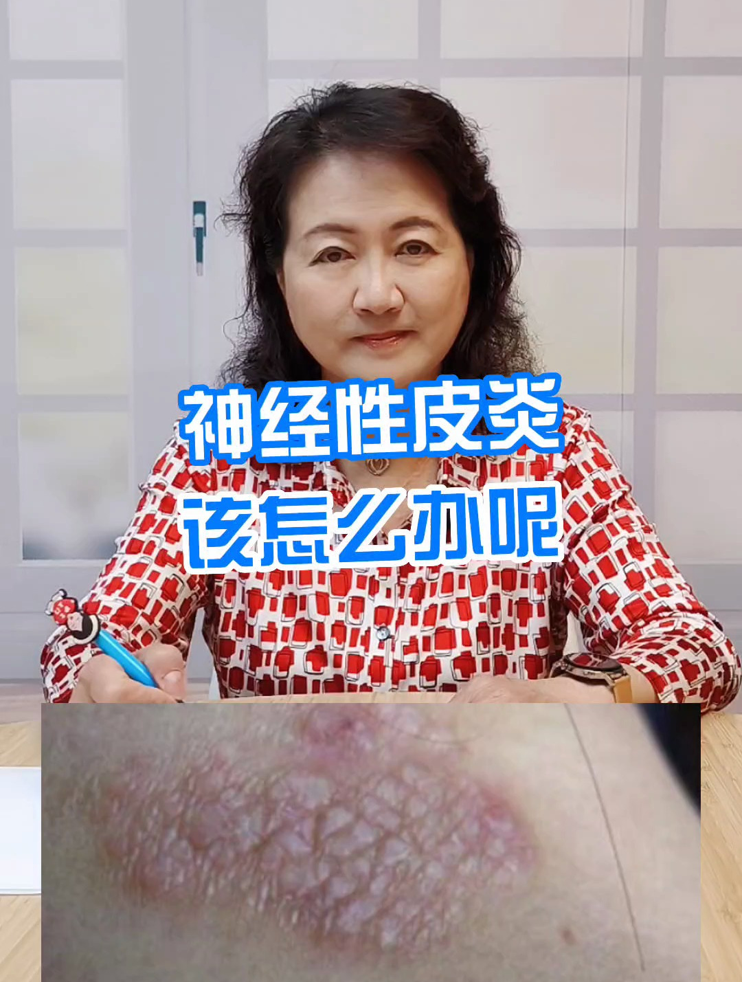 神经性皮炎该怎么办呢