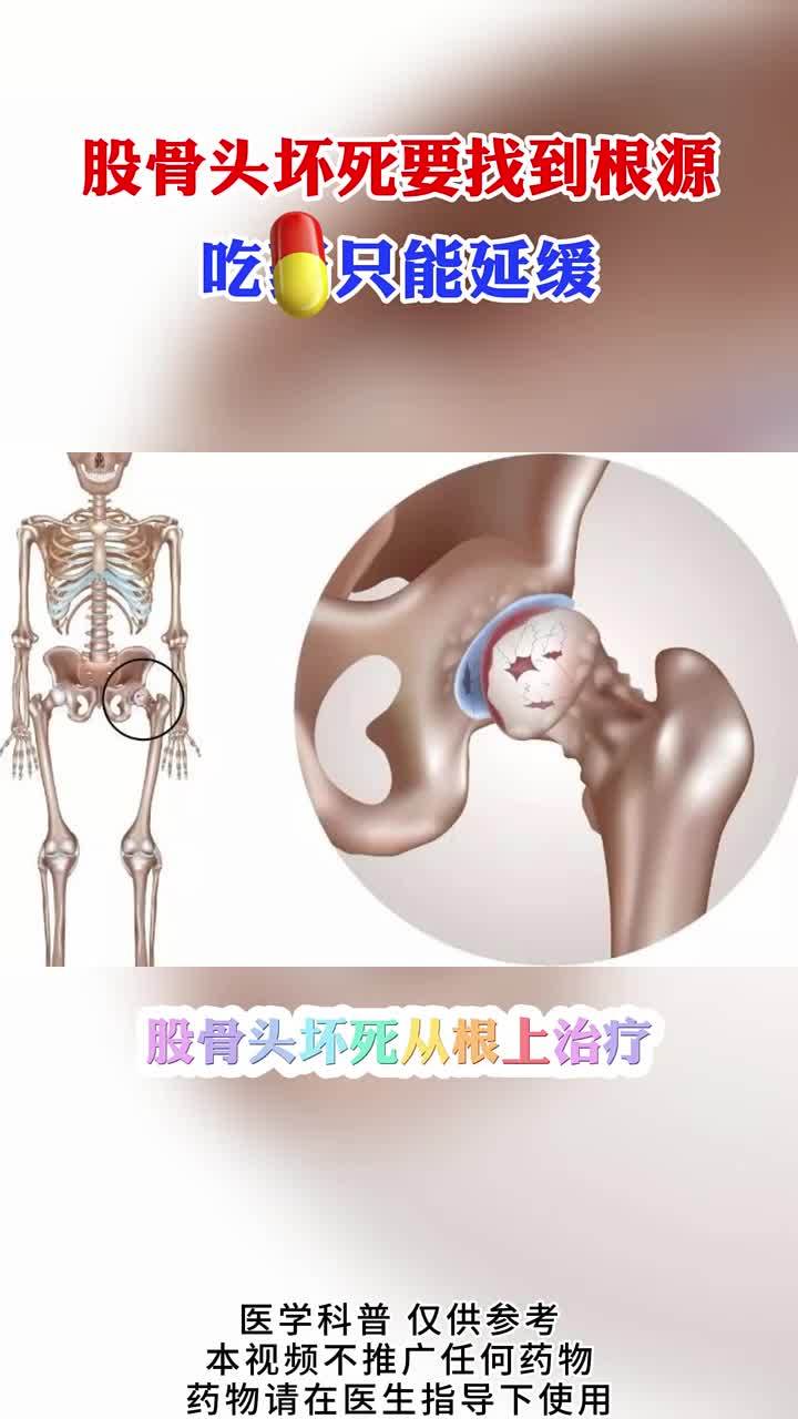 股骨头坏死找到根源,就好治了
