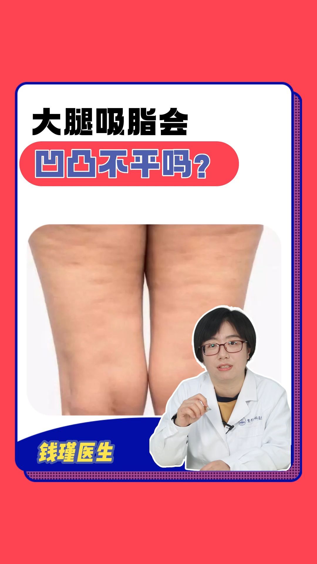 大腿吸脂会凹凸不平吗