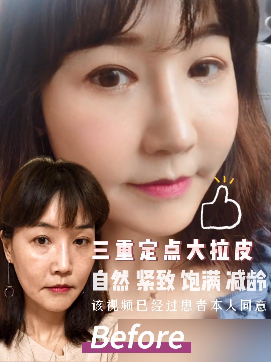 51岁三重定点拉皮手术30天前后效果对比