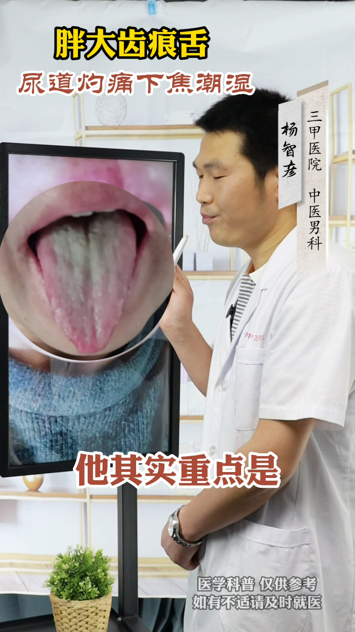 舌诊案例:年轻小伙子,局部潮湿,胖大齿痕舌,尿道灼热