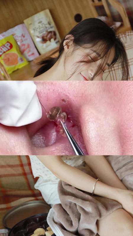 恶心的黑头太多了这个工具解决黑头很好用一次解决问题