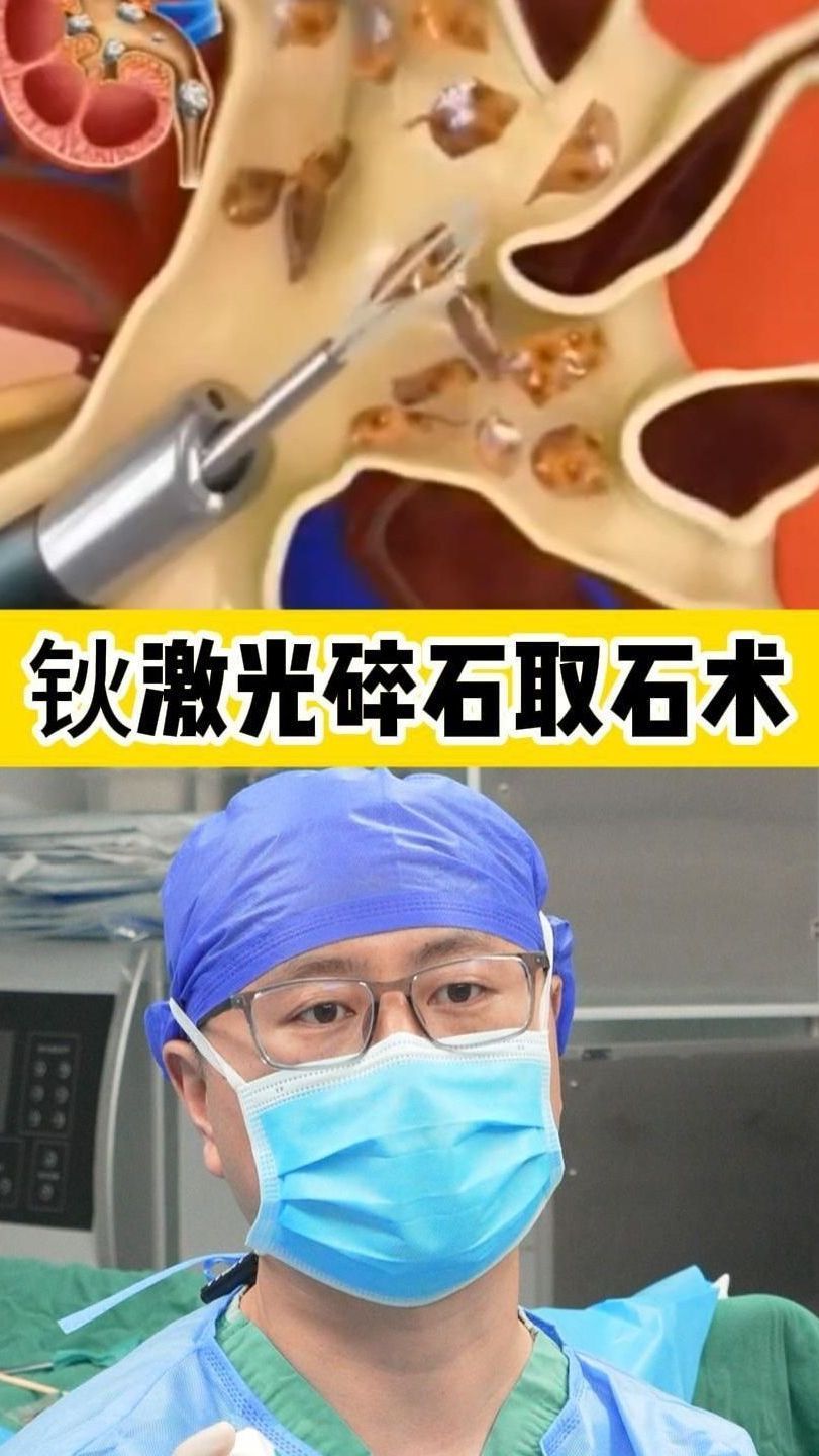 钬激光碎石取石术,3d动画演示