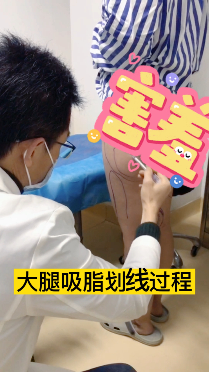 你知道为什么吸脂前要划线吗