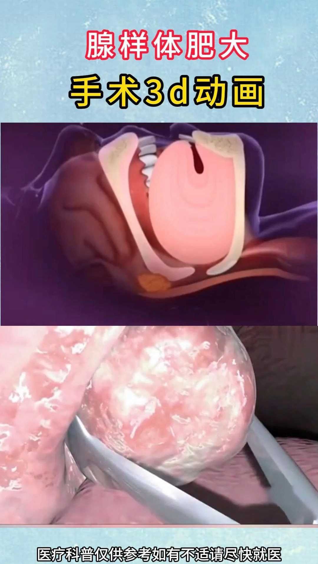 腺样体肥大手术3d