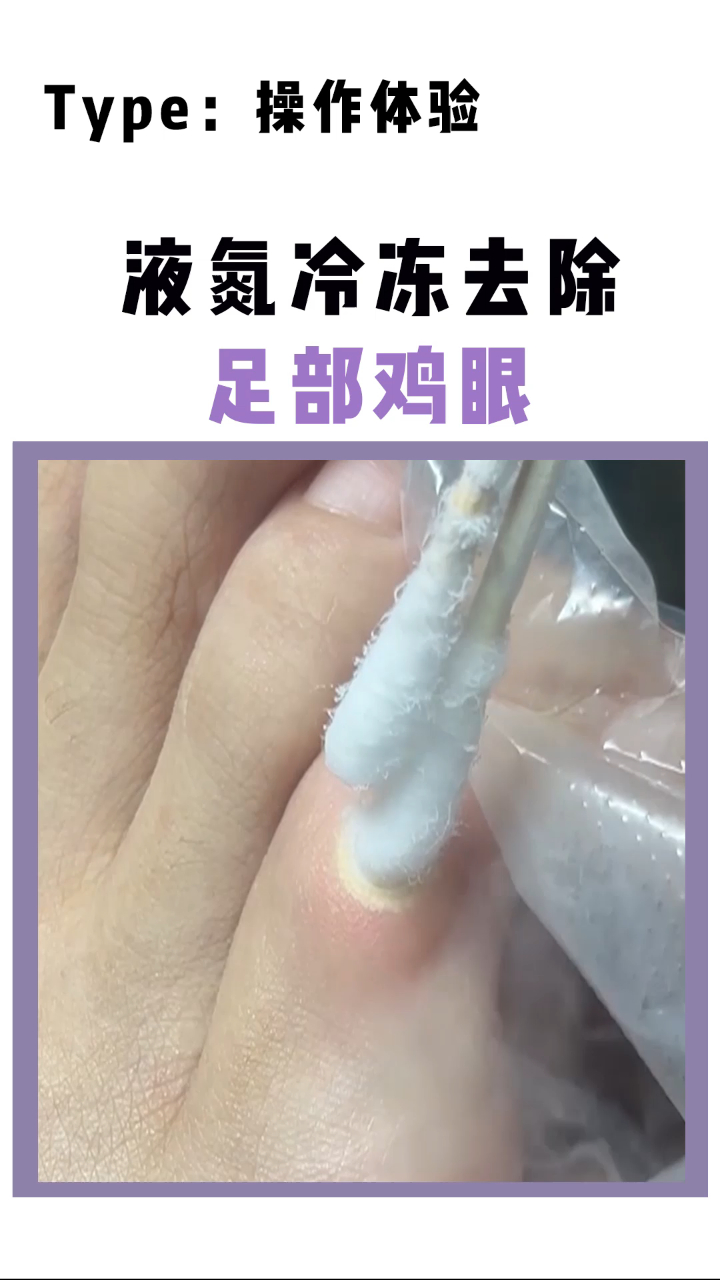长了鸡眼,可以到医院选择冷冻处理!-度小视