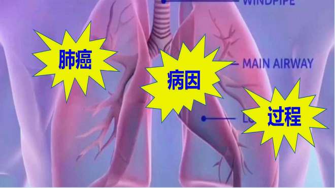 [图]知道原因才好预防：肺癌病因是啥？肺癌如何进展？通过3D讲解