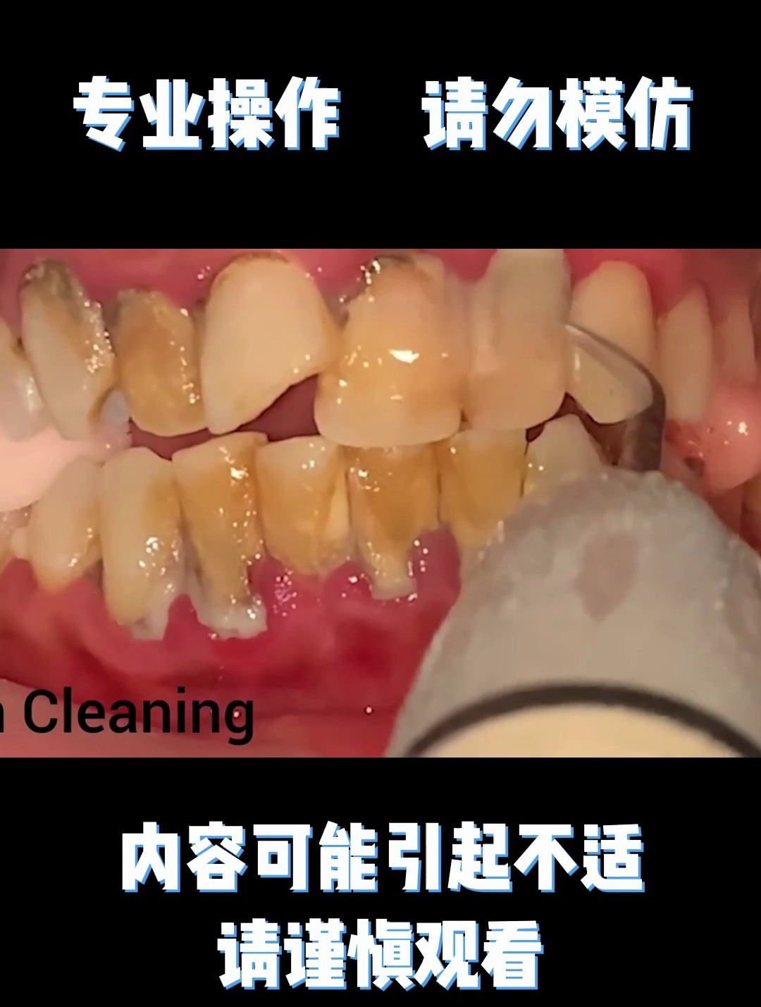 不好好刷牙的后果,看着洗牙过程都疼,要注意口腔清洁