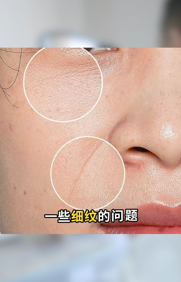 脸上干纹细纹,该怎么解决?