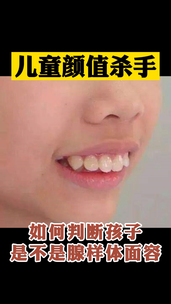 教你如何判断孩子是不是腺样体面容