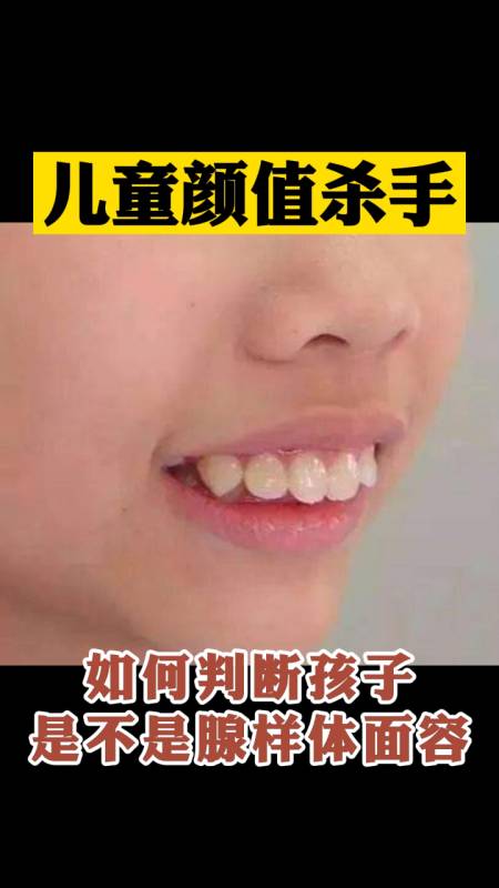 教你如何判断孩子是不是腺样体面容