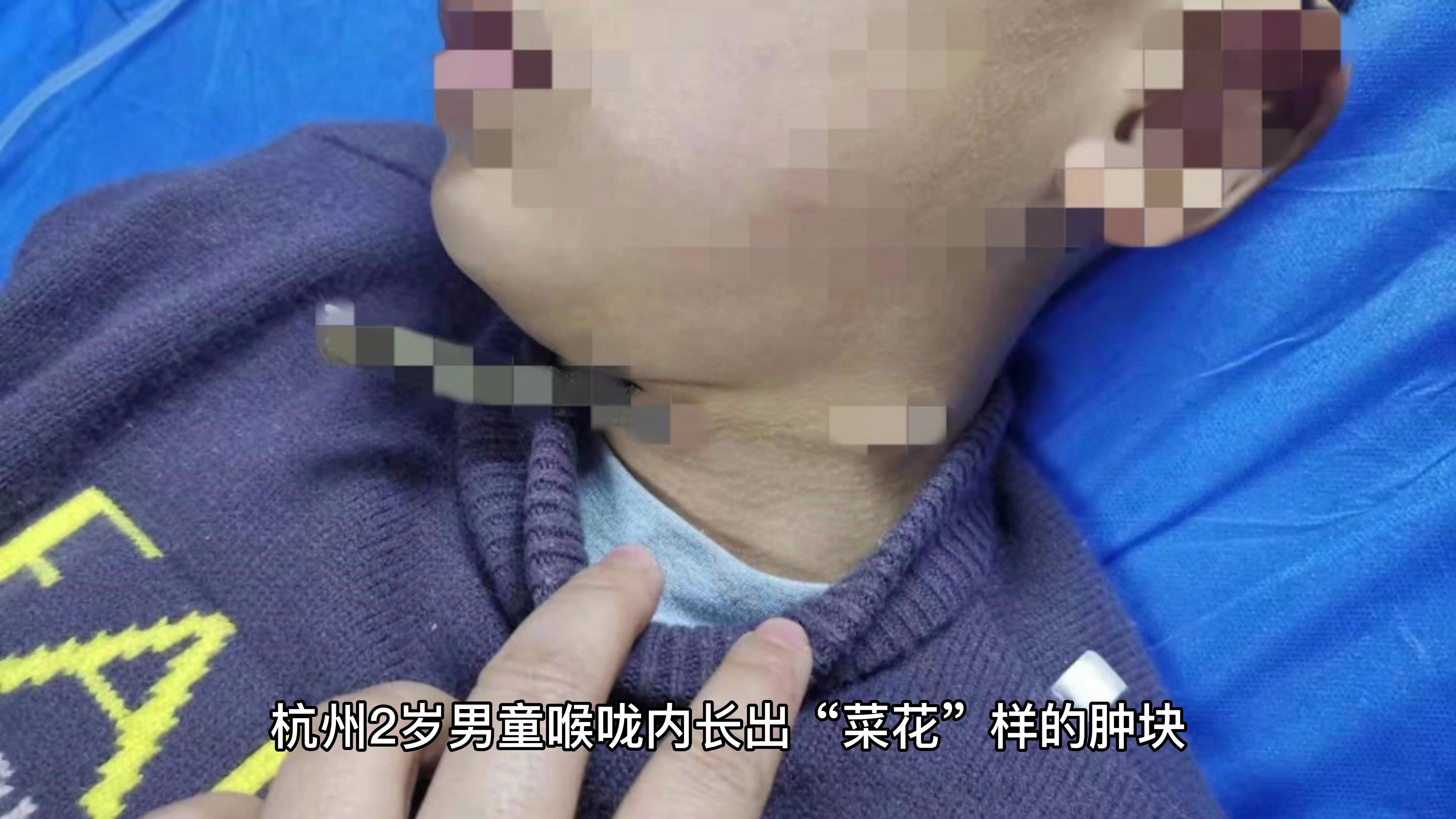 小心了!2岁男童喉咙内长出“菜花”样的肿块,确诊感染HPV!