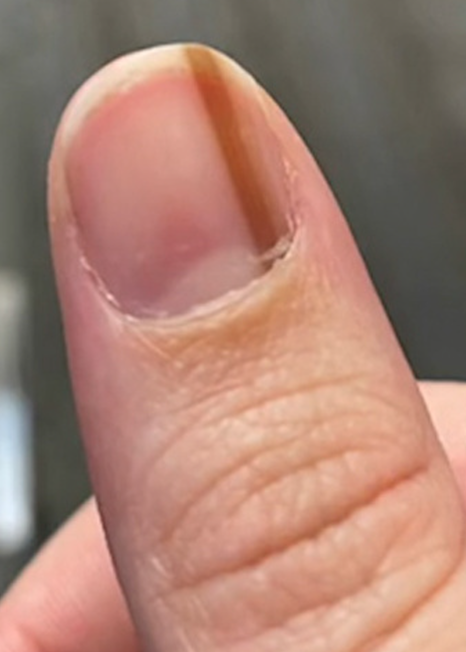 女子指甲长出深色条纹长达10年,去医院一查发现竟是皮肤癌?-度小视