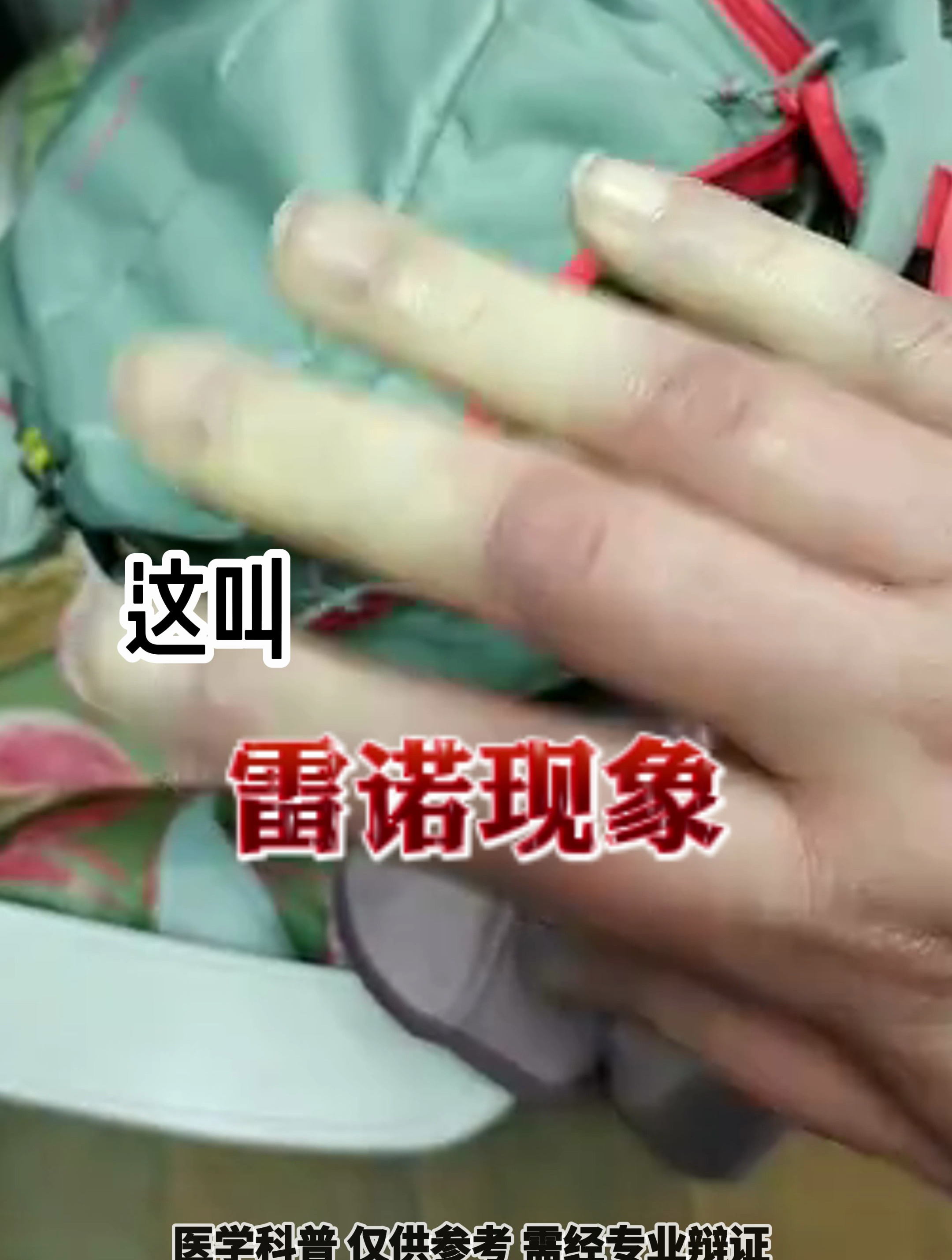 手指遇冷发白发紫,这是风湿免疫疾病,叫雷诺现象