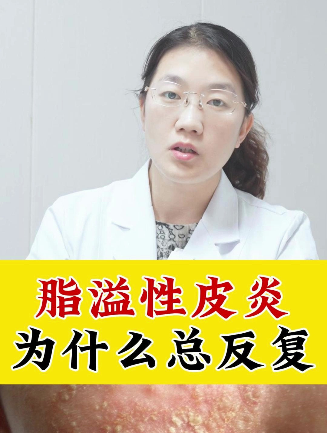 脂溢性皮炎为什么总反复