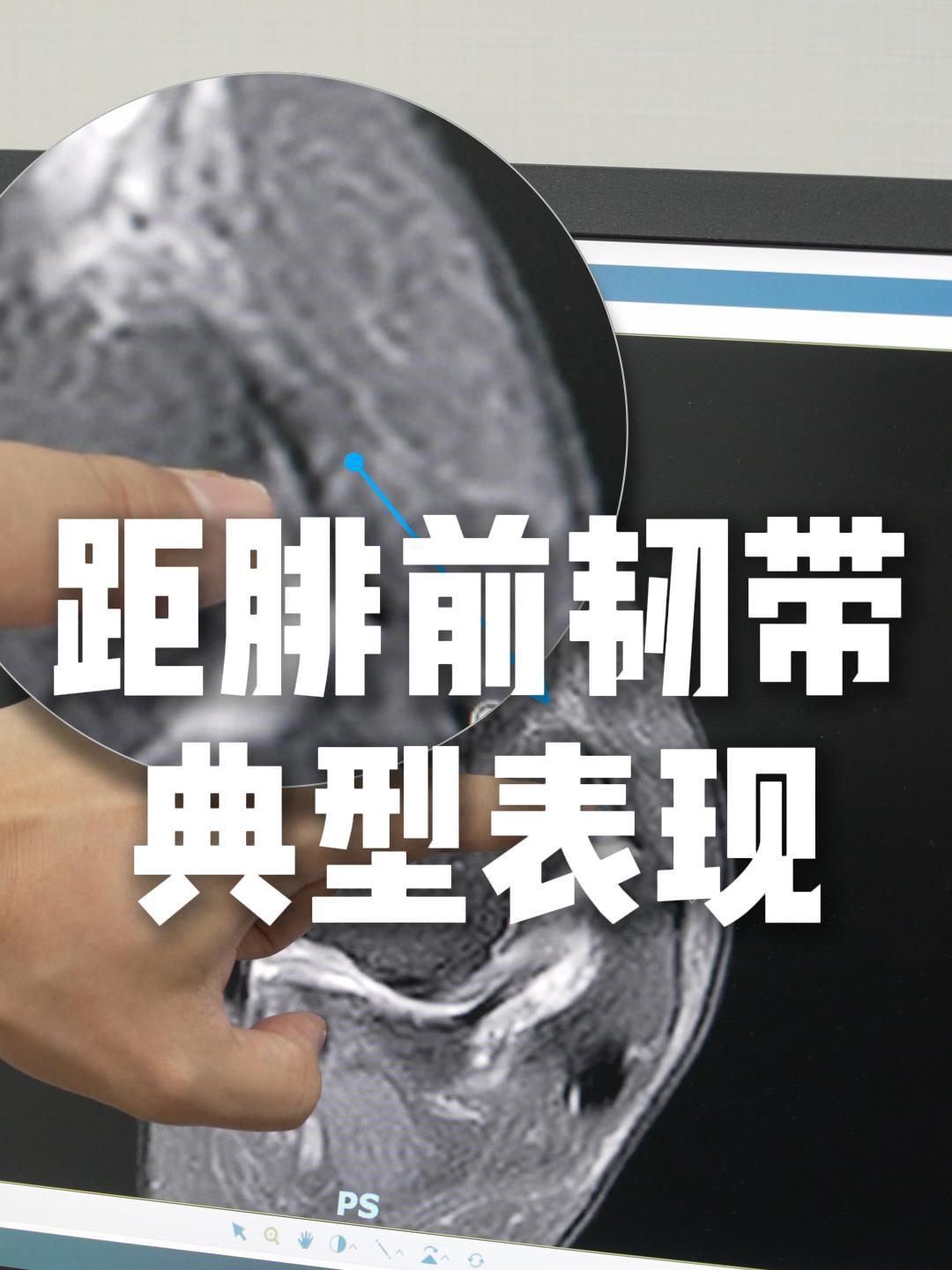 距腓前韧带磁共振下典型表现