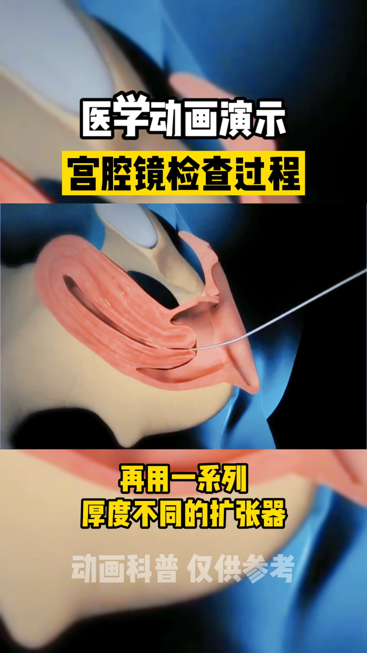 宫腔镜检查全过程30秒带你看完