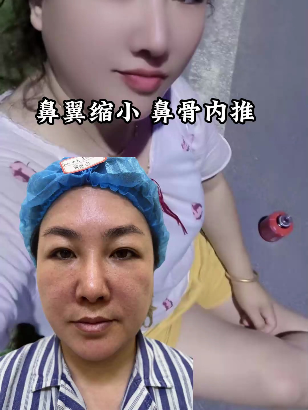 软糖鼻案例之鼻翼缩小 鼻骨内推