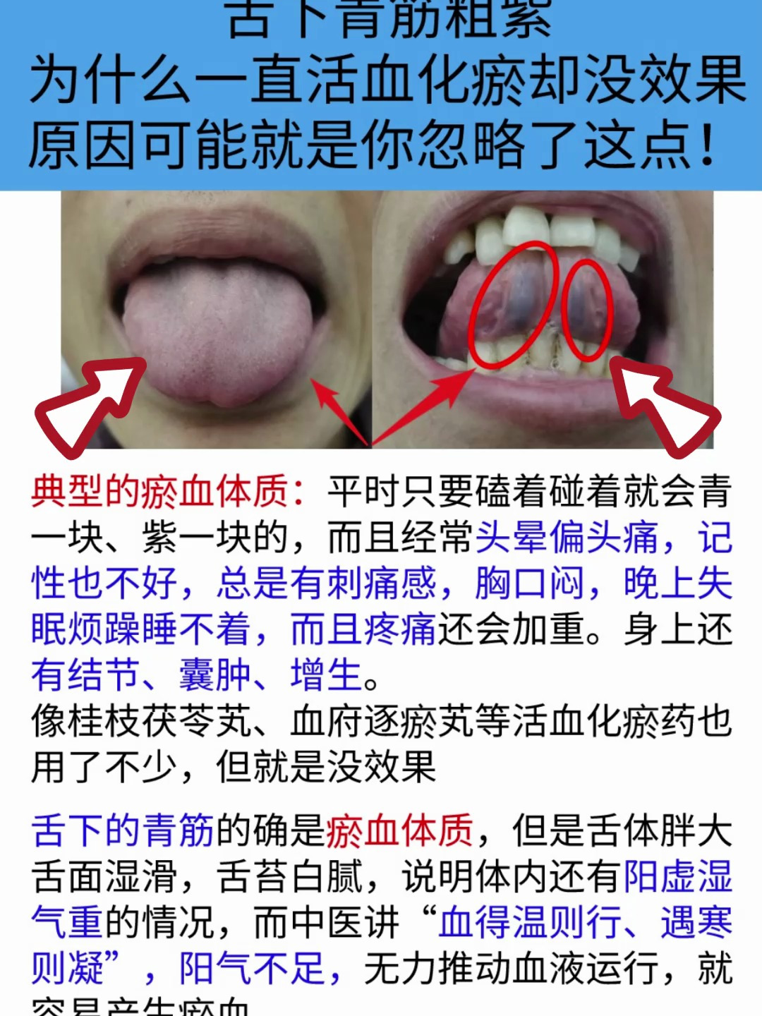 舌象分析:舌下青筋粗紫,可能是你忽略了这一点?