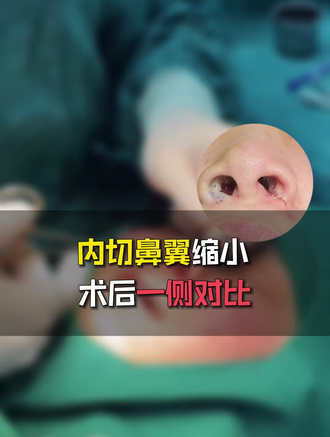 内切鼻翼缩小,术后一侧对比!