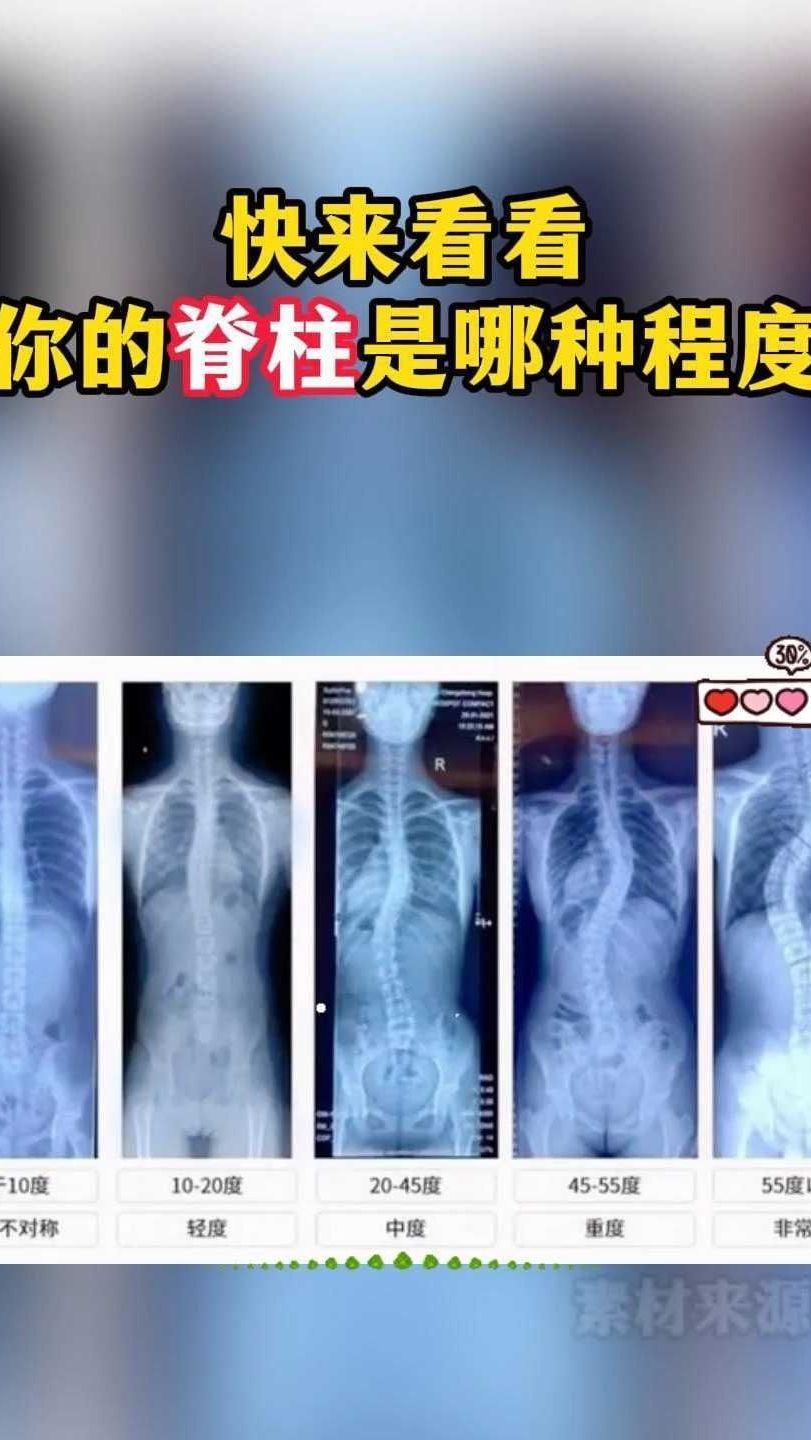 快来看看你的脊柱侧弯是哪种程度?