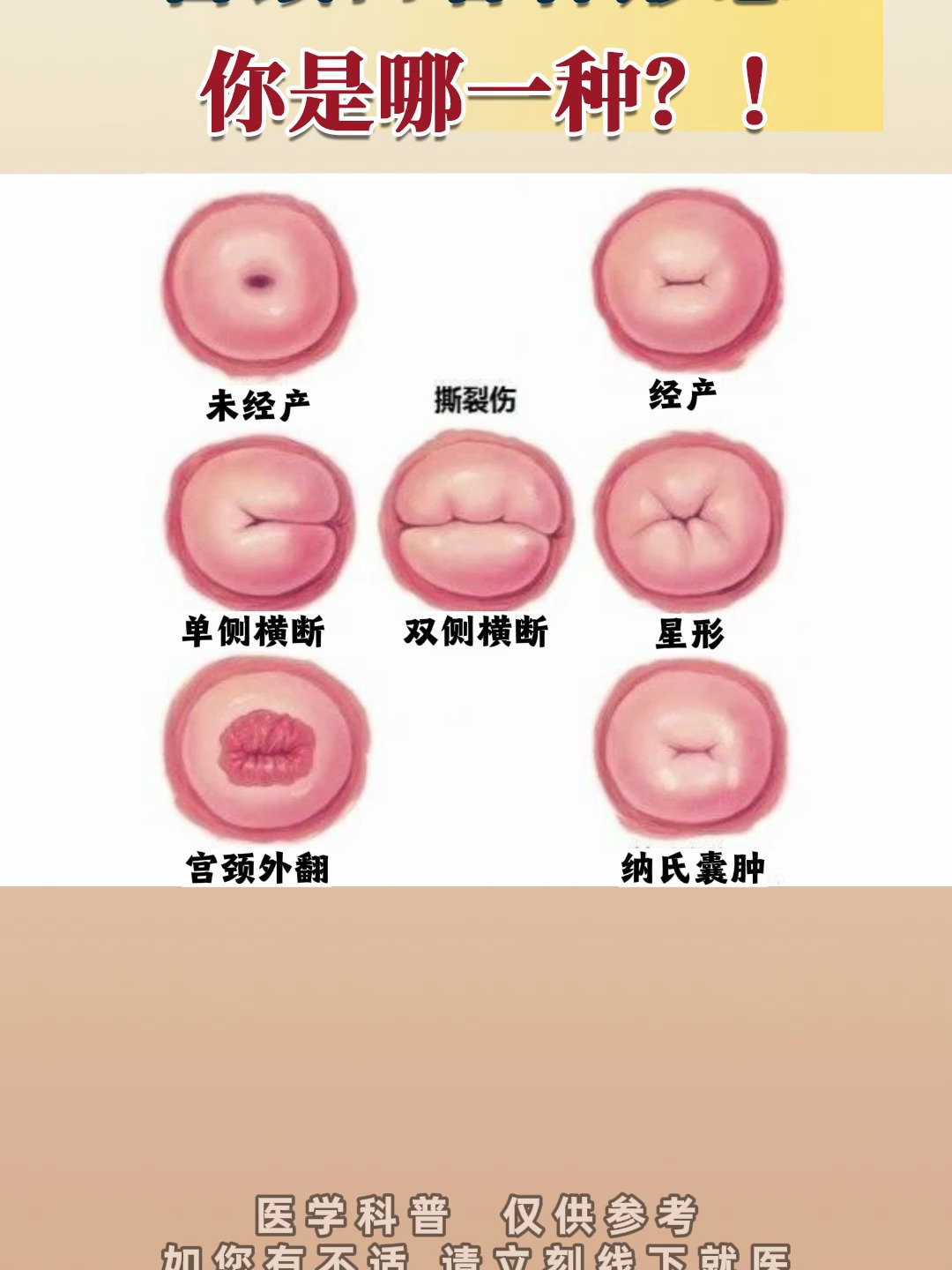 女性宫颈口的各种形态,你是哪一种?