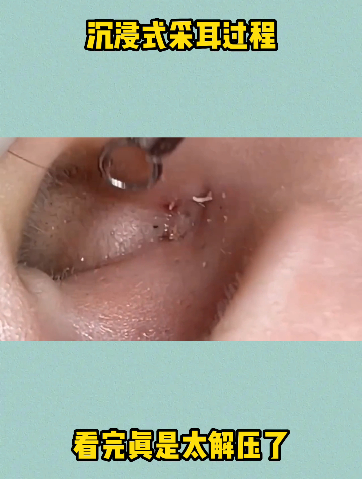 大哥耳朵里长黑头,经过师傅的清理,直接挖出一大块耳垢好解压
