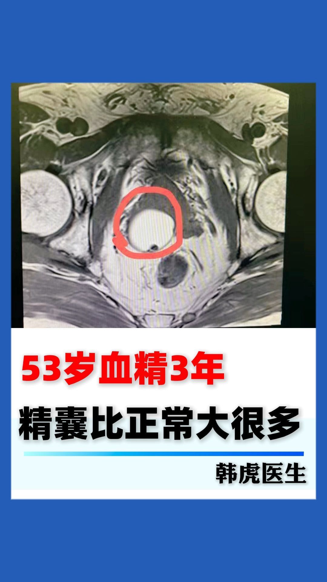 严重血精症的图片图片