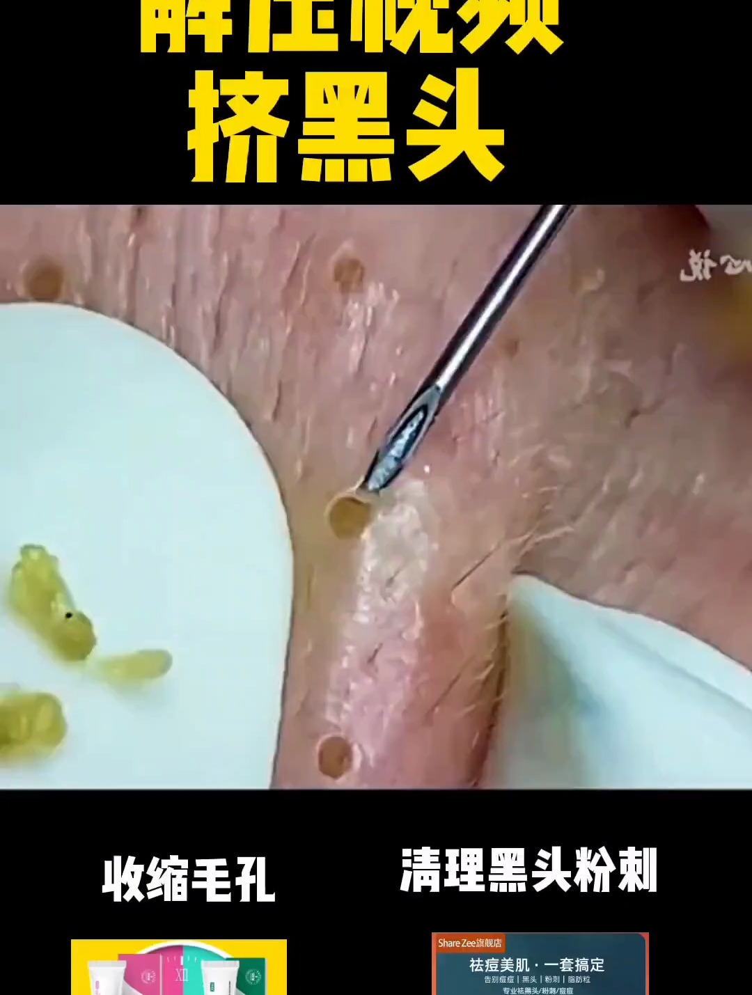 強迫症必看解壓擠黑頭!