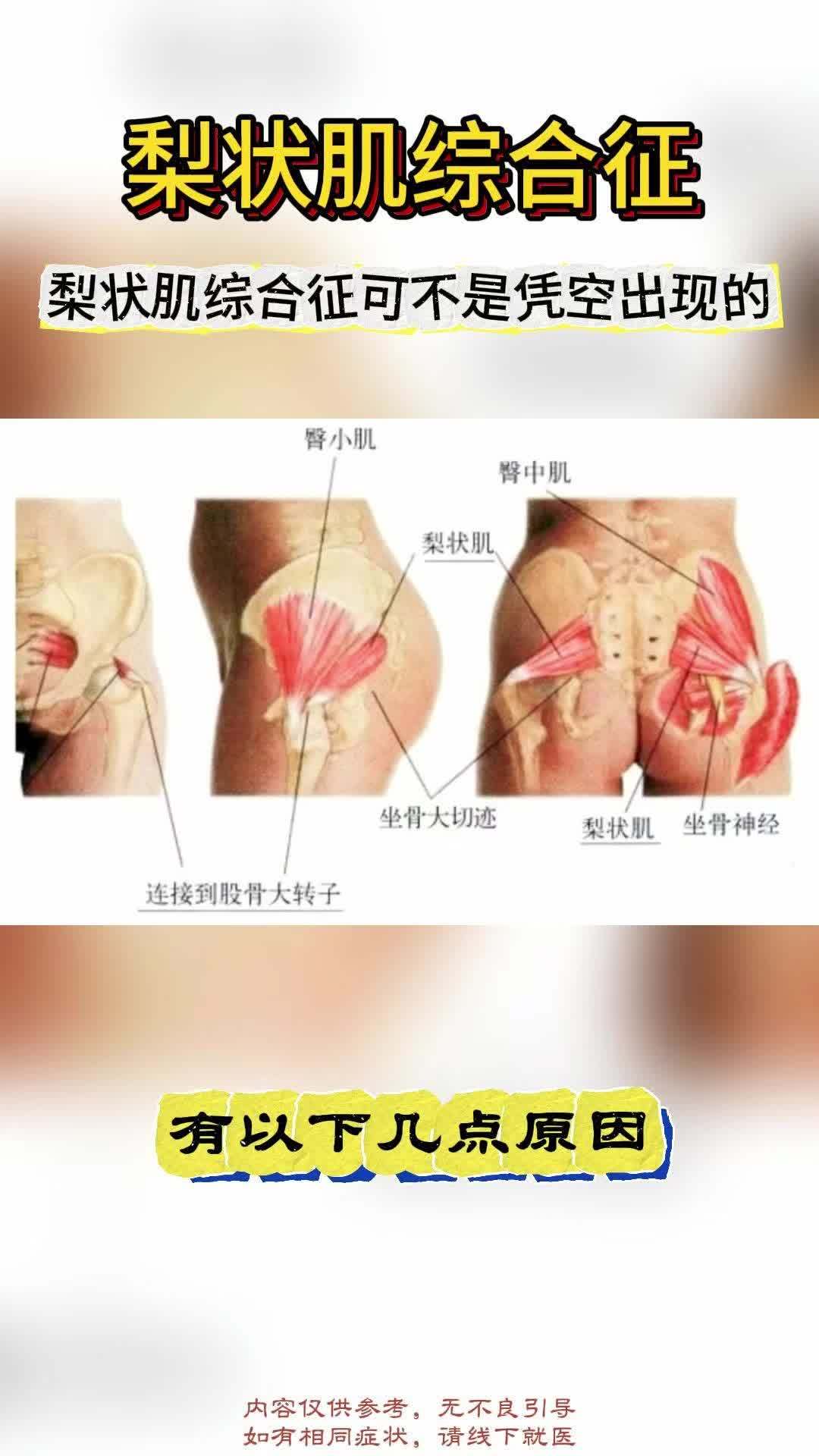 揭开梨状肌综合症引起的神秘面纱
