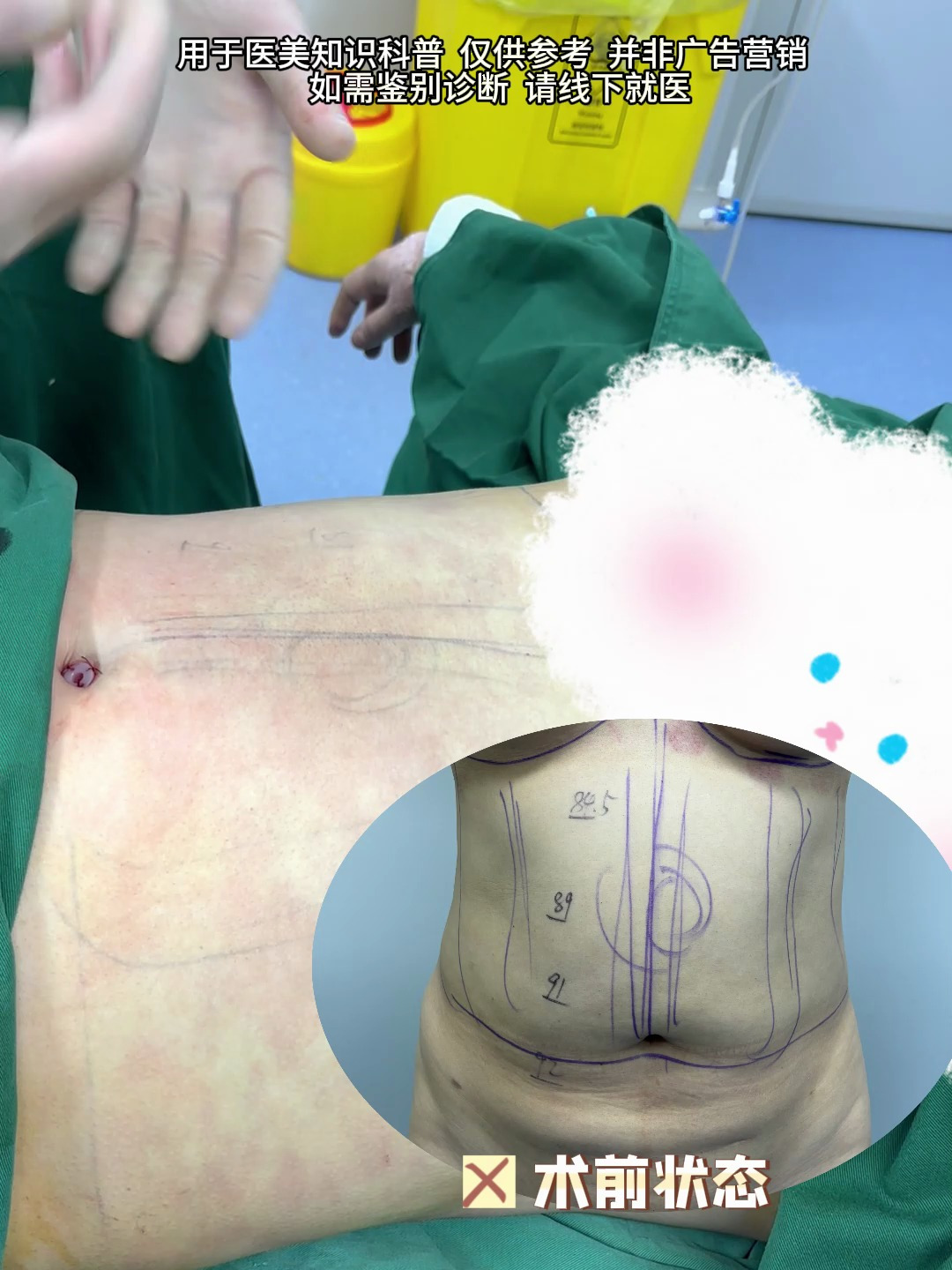 42岁求美者来做腰腹部的吸脂修复,术后的脂肪厚度明显瘦下去了