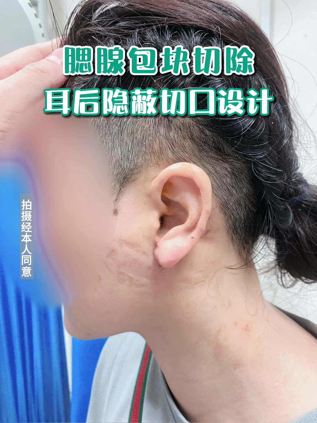 腮腺包块耳后隐蔽设计